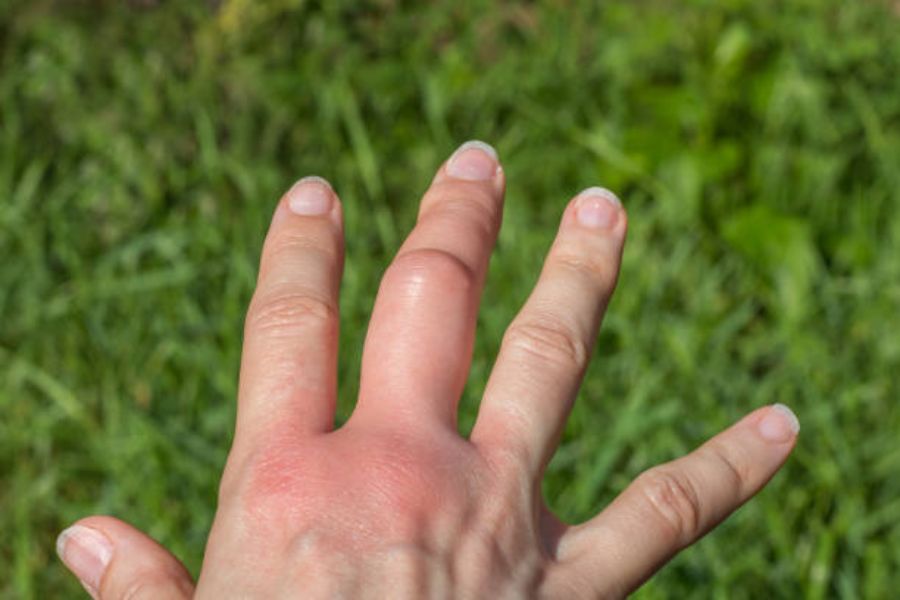 Side effects of a bee sting, a swollen hand and fingers.