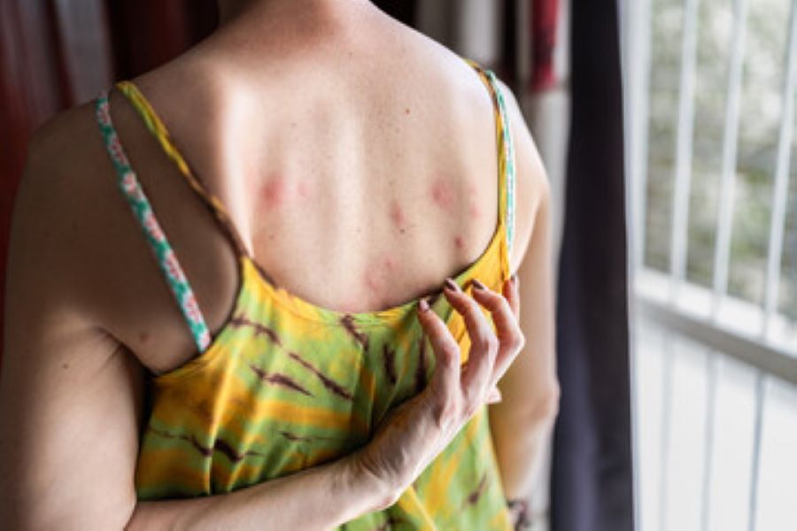 Bed bugs bites on a humans back.